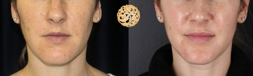 Bbl Laser Pigmentation Before & After