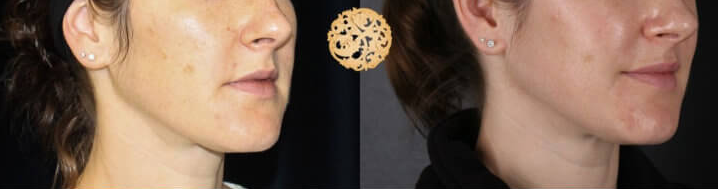 Bbl Laser Pigmentation Before & After