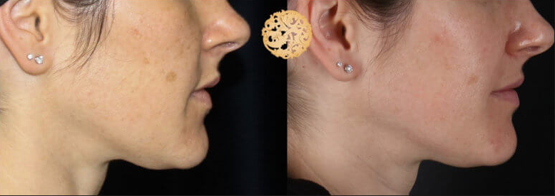 Bbl Laser Pigmentation Before & After