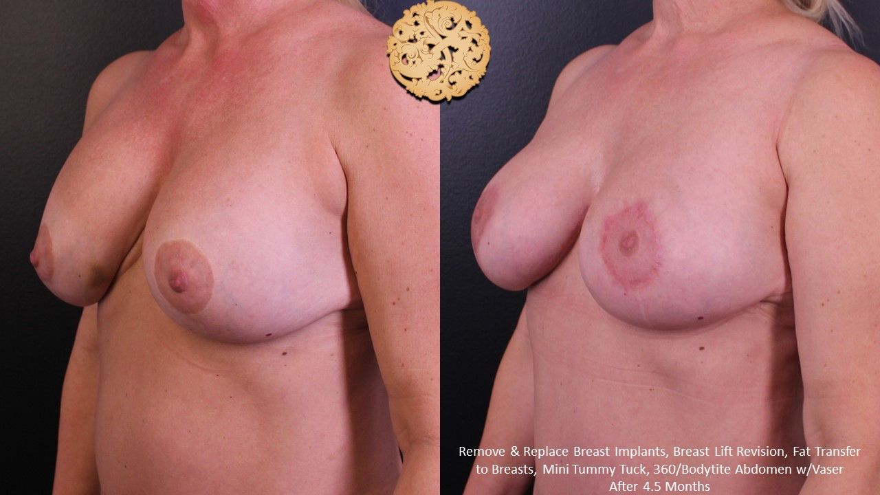 Fat Transfer To Breasts Before & After