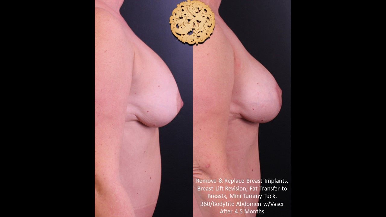 Fat Transfer To Breasts Before & After