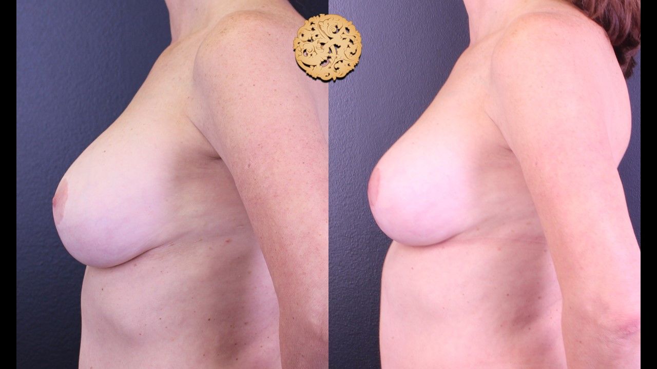 Fat Transfer To Breasts Before & After