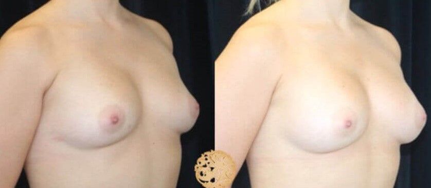 Fat Transfer To Breasts Before & After