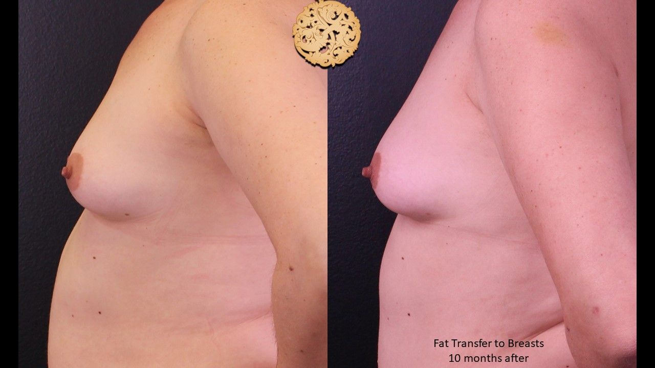 Fat Transfer To Breasts Before & After