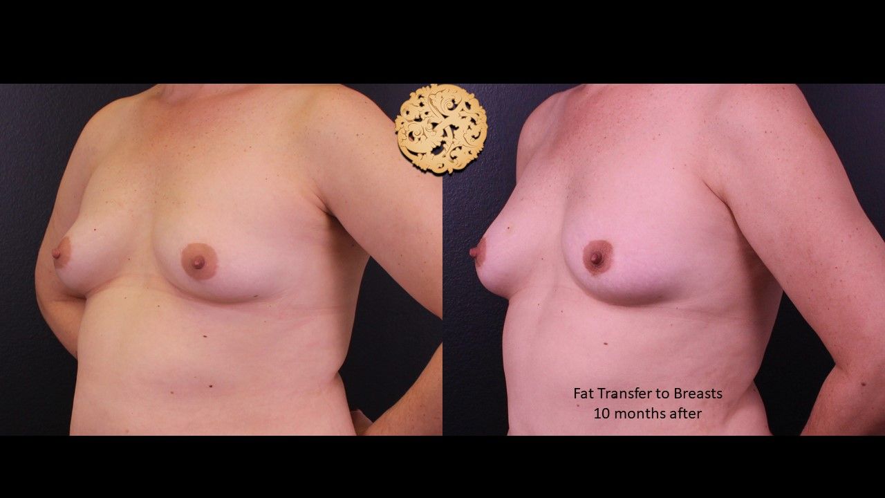 Fat Transfer To Breasts Before & After