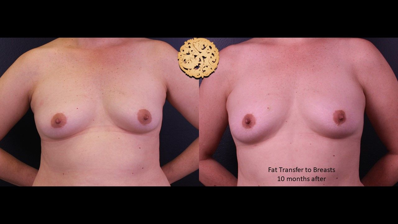 Fat Transfer To Breasts Before & After