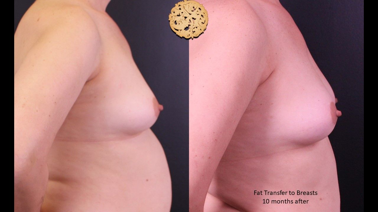 Fat Transfer To Breasts Before & After