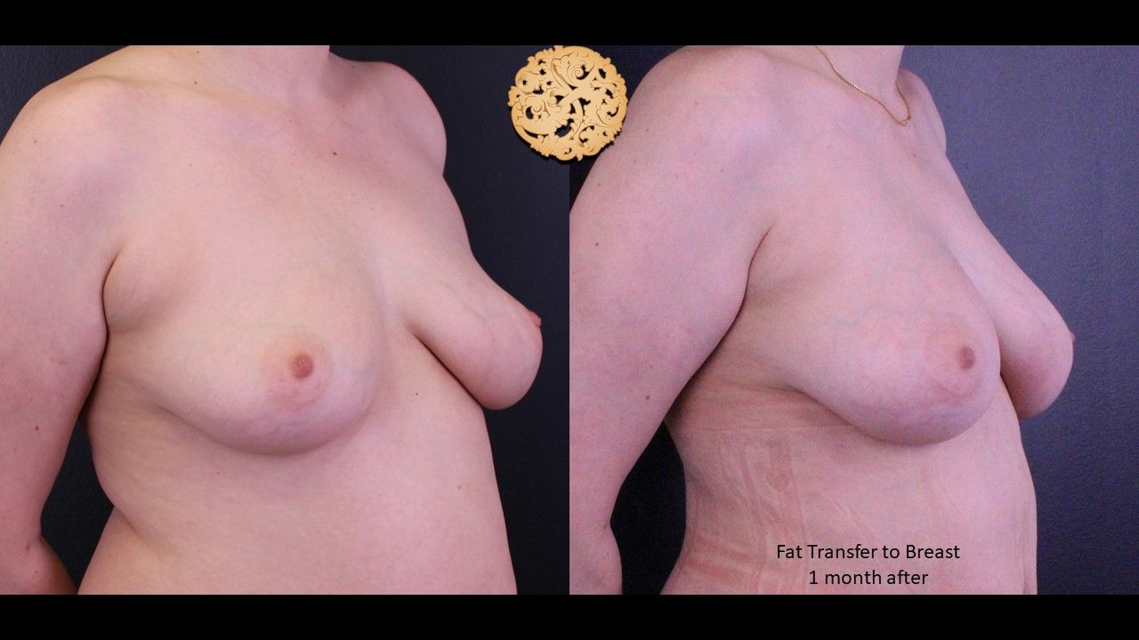 Fat Transfer To Breasts Before & After
