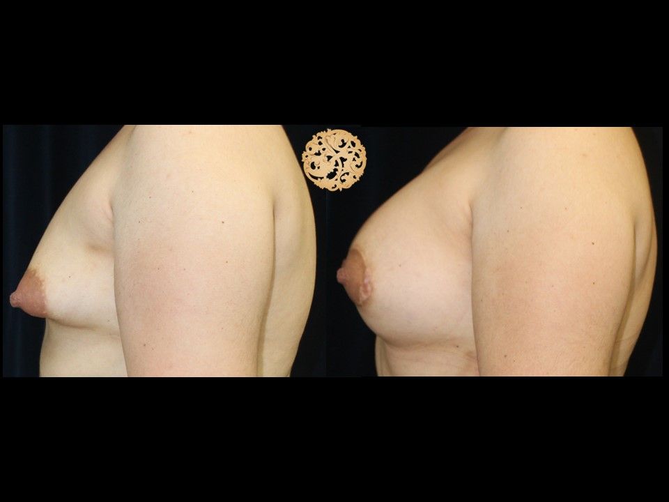 Fat Transfer To Breasts Before & After