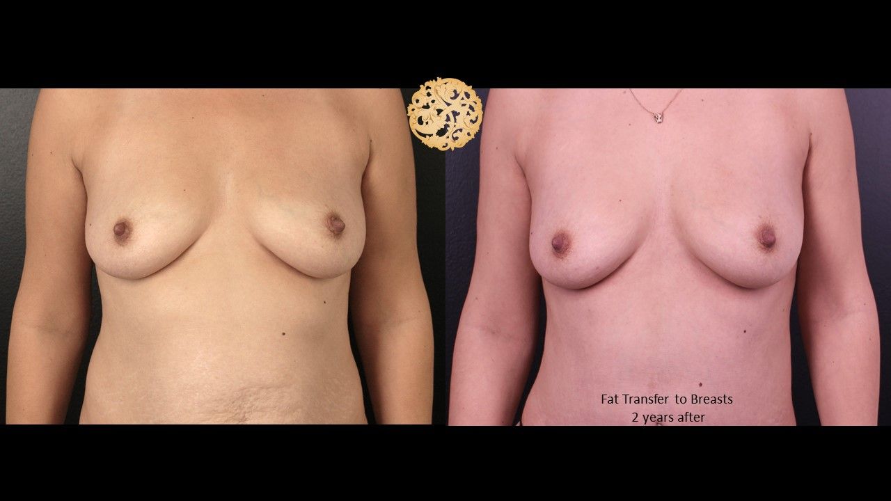 Fat Transfer To Breasts Before & After