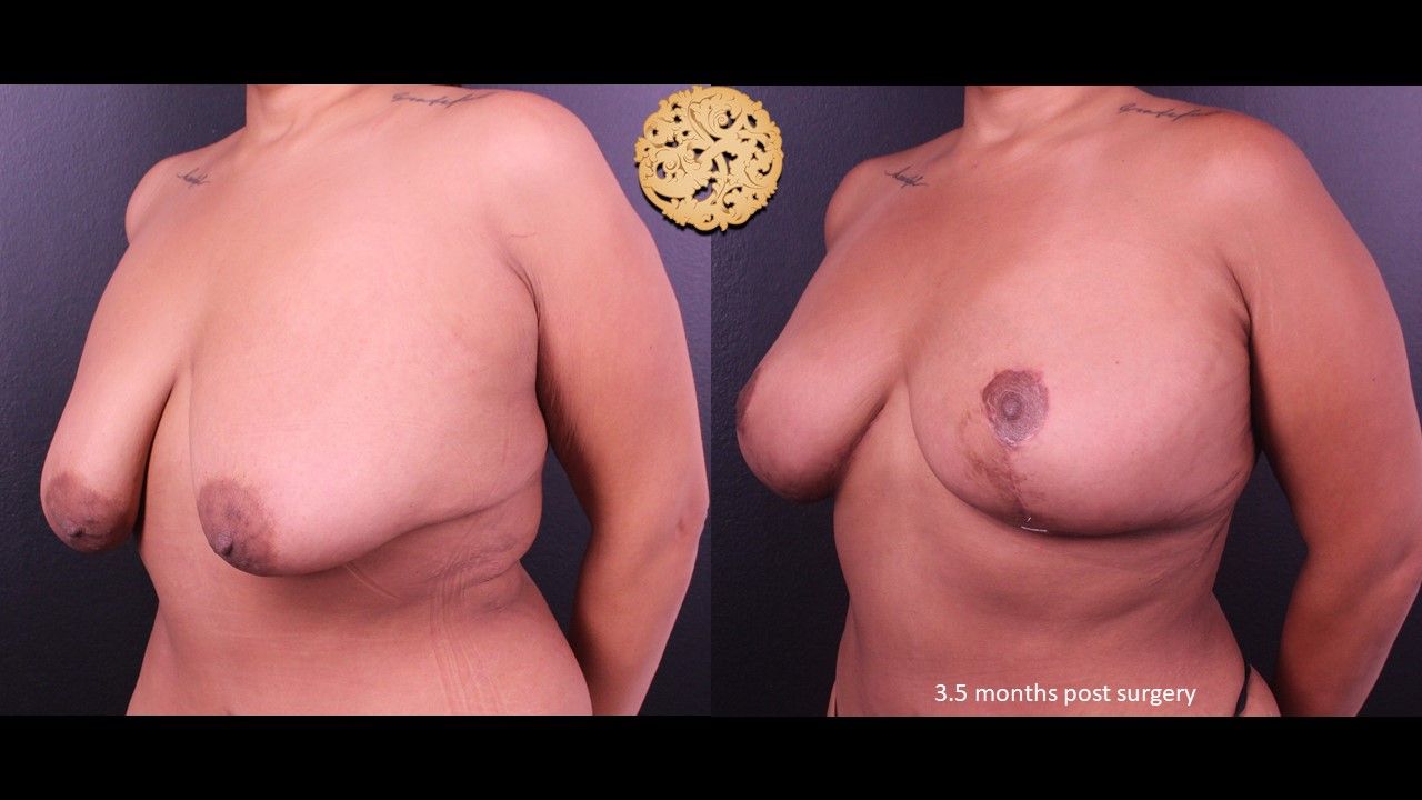 Fat Transfer To Breasts Before & After