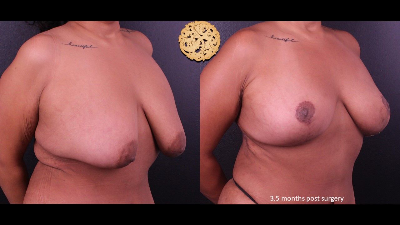 Fat Transfer To Breasts Before & After