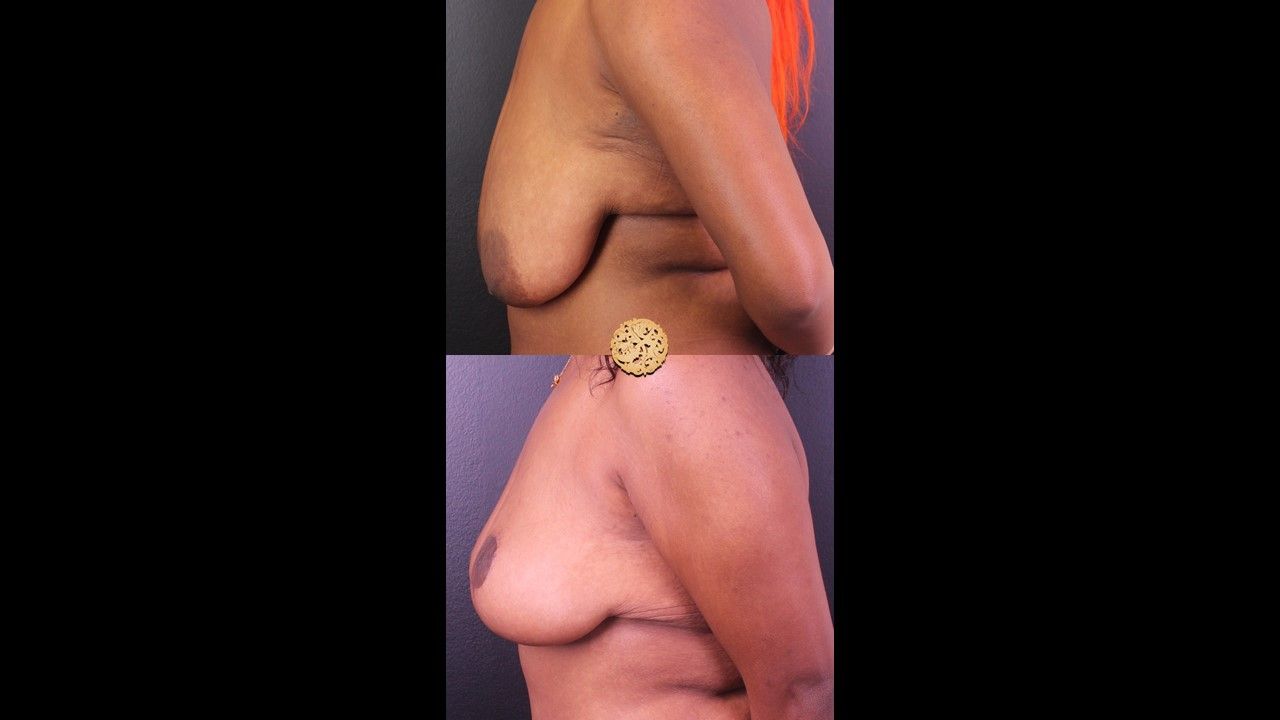 Fat Transfer To Breasts Before & After