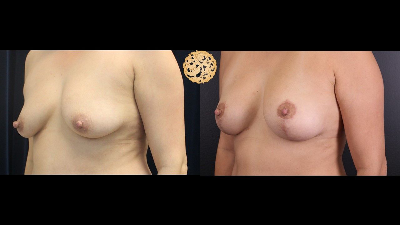 Fat Transfer To Breasts Before & After