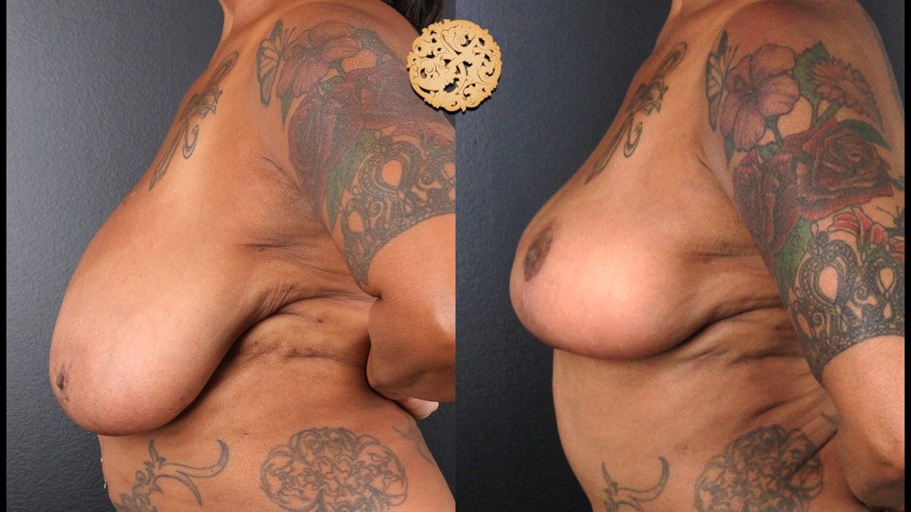 Fat Transfer To Breasts Before & After