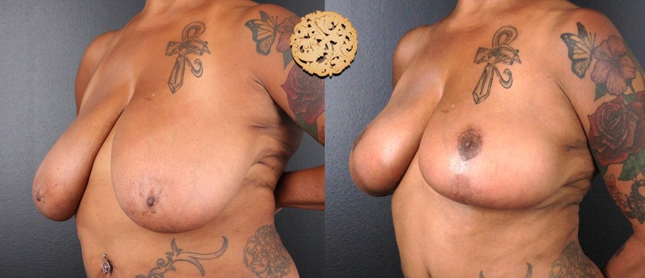 Fat Transfer To Breasts Before & After
