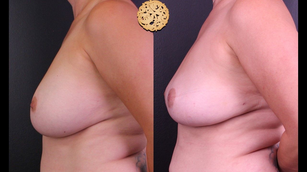 Fat Transfer To Breasts Before & After