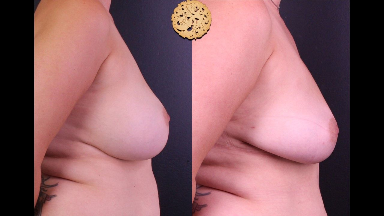 Fat Transfer To Breasts Before & After