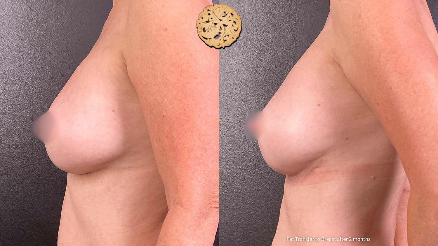 Fat Transfer To Breasts Before & After