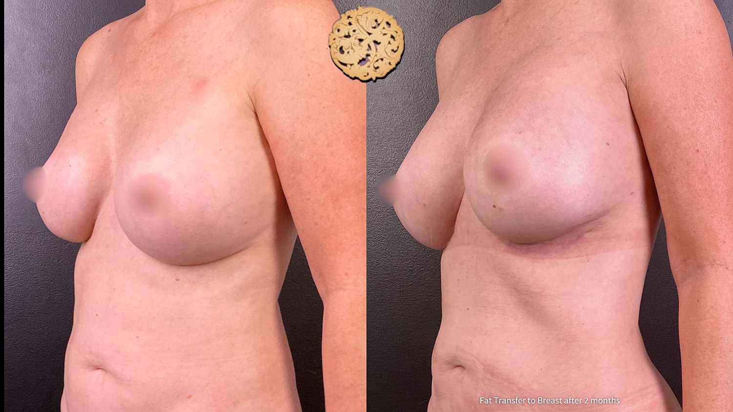 Fat Transfer To Breasts Before & After