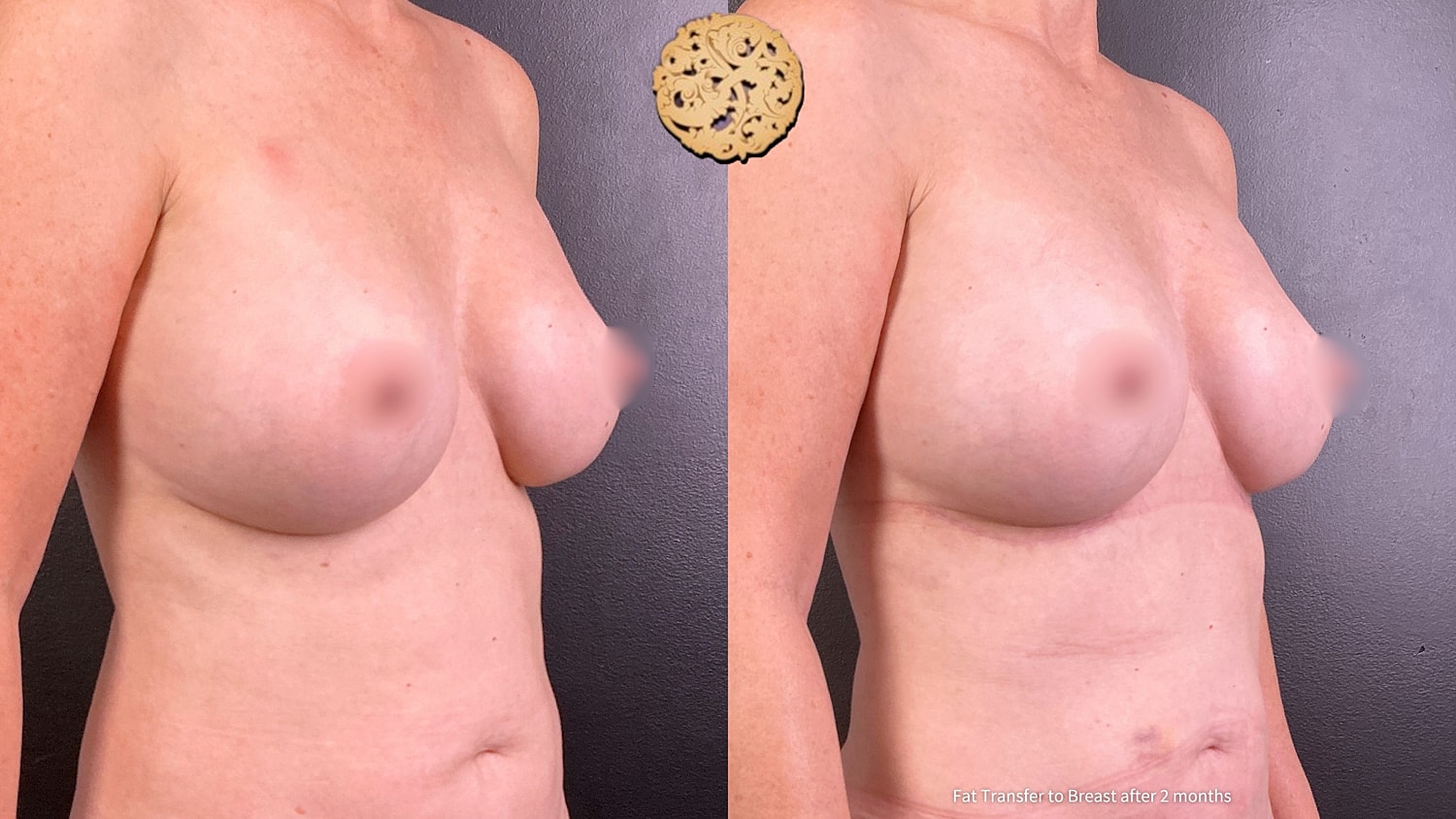 Fat Transfer To Breasts Before & After