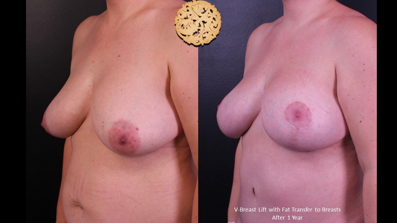 Fat Transfer To Breasts Before & After