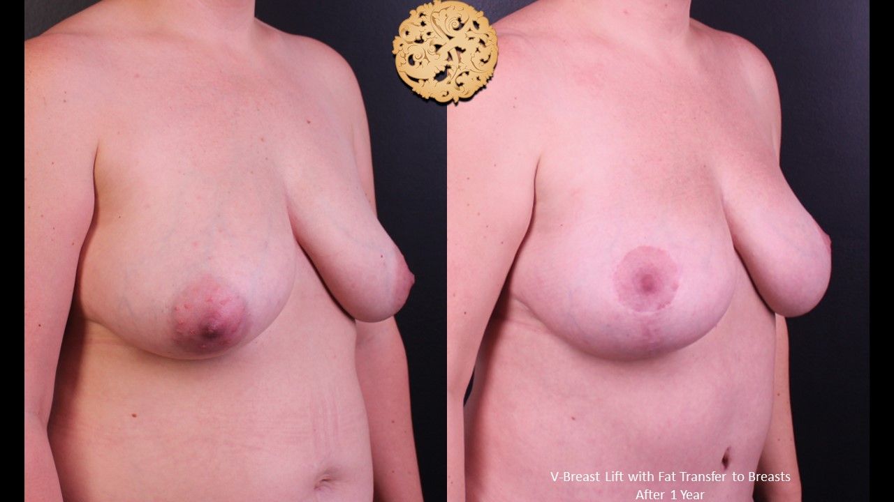 Fat Transfer To Breasts Before & After