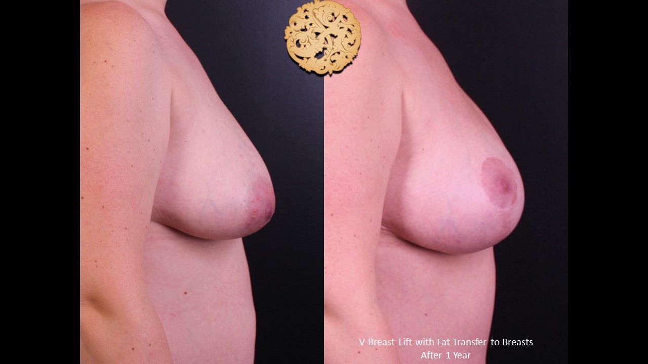 Fat Transfer To Breasts Before & After