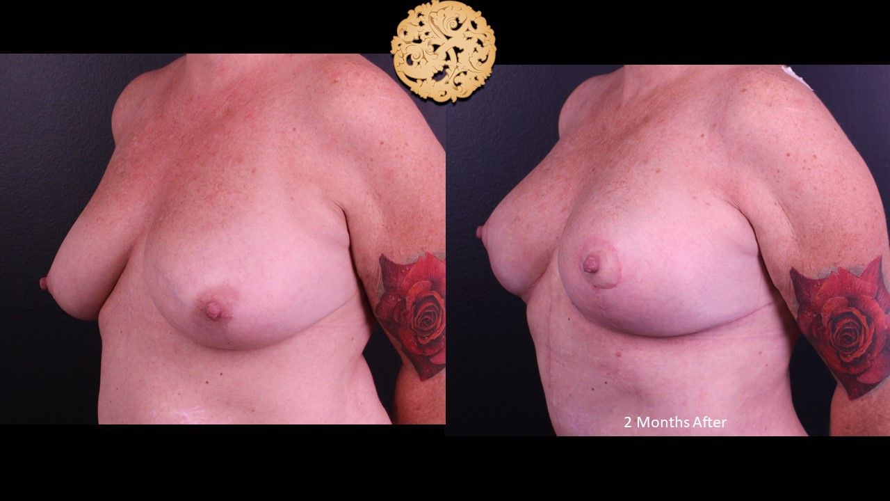 Fat Transfer To Breasts Before & After