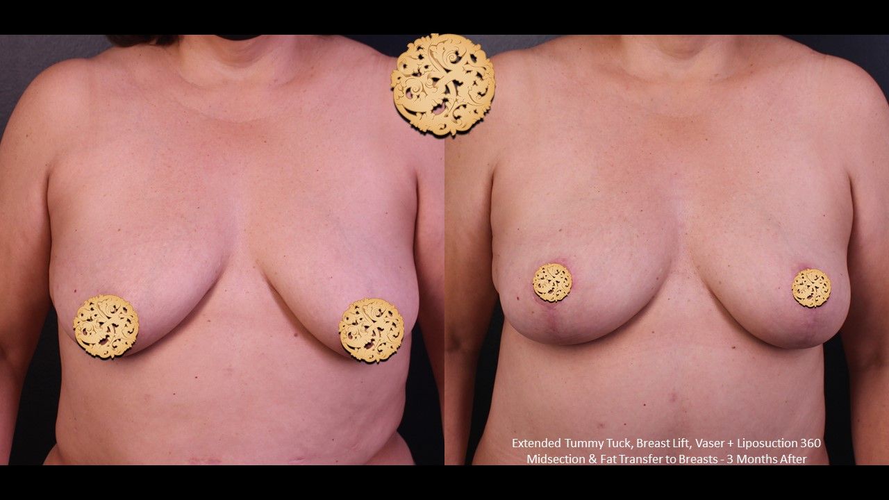 Fat Transfer To Breasts Before & After