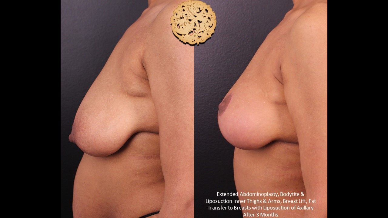 Fat Transfer To Breasts Before & After
