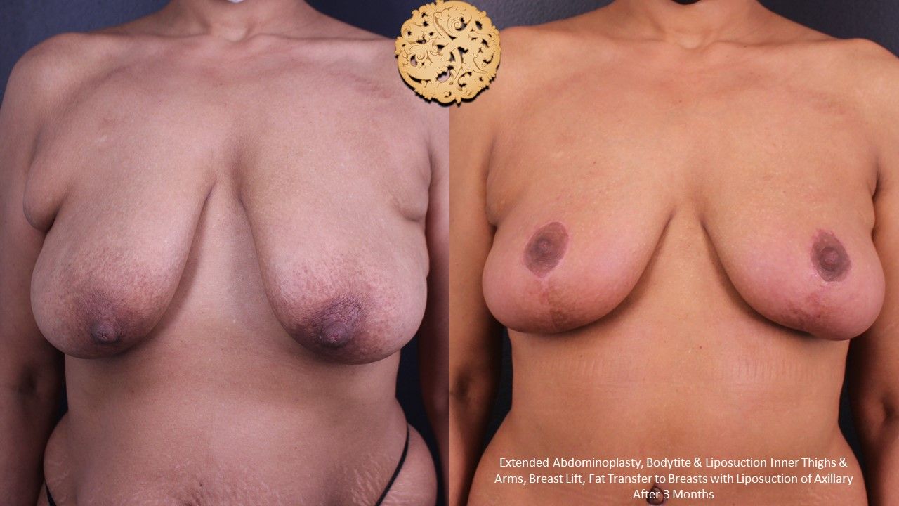 Fat Transfer To Breasts Before & After