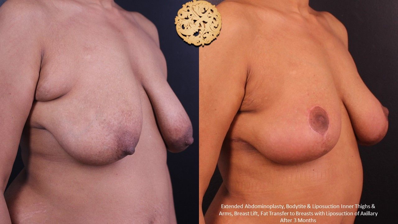 Fat Transfer To Breasts Before & After