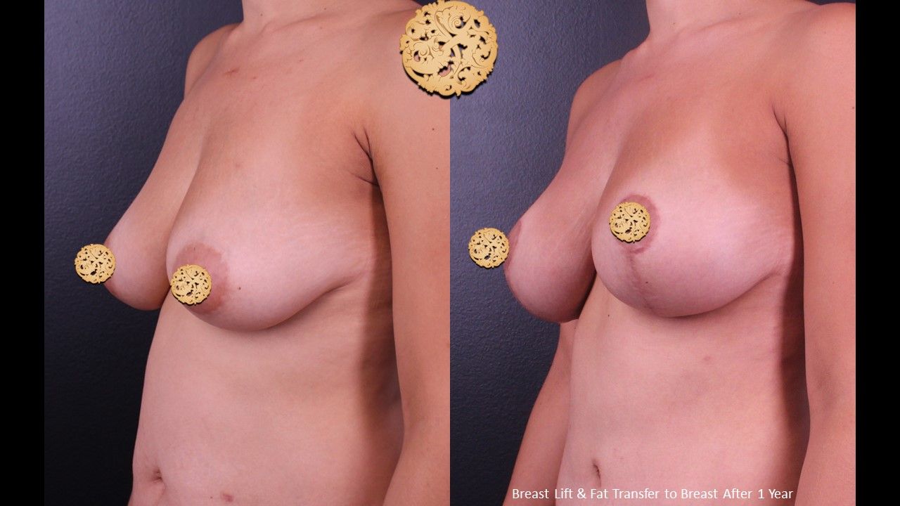 Fat Transfer To Breasts Before & After