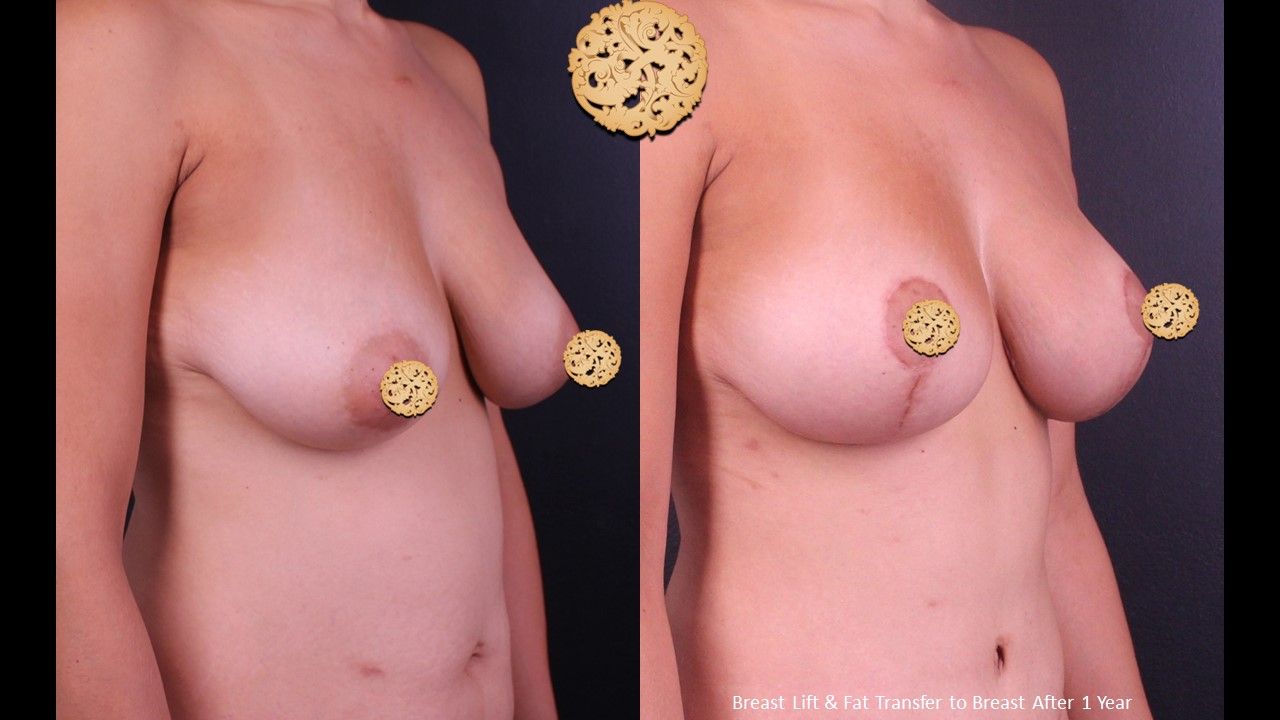 Fat Transfer To Breasts Before & After