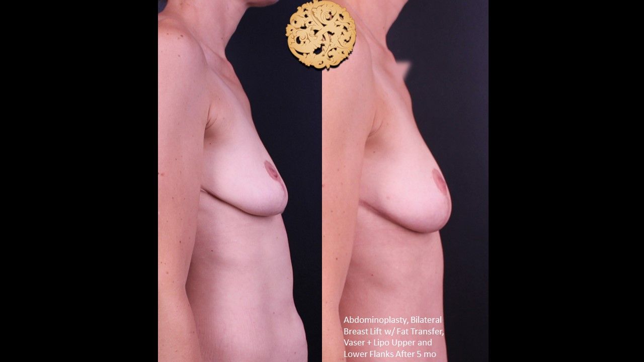 Fat Transfer To Breasts Before & After