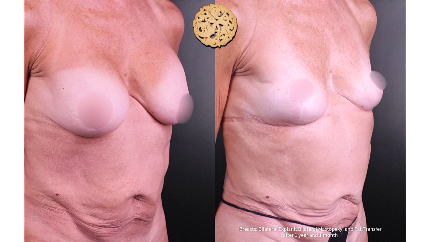 Fat Transfer To Breasts Before & After