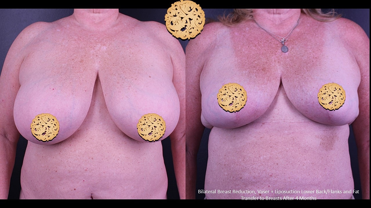 Fat Transfer To Breasts Before & After
