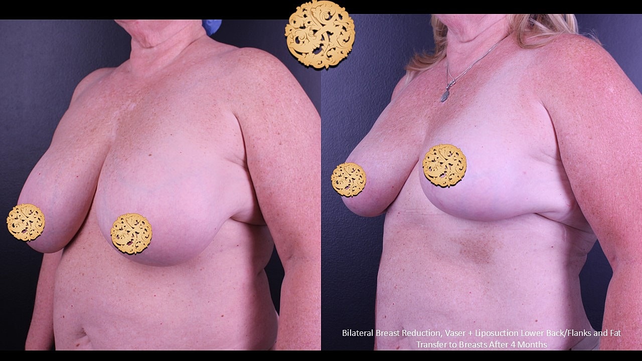 Fat Transfer To Breasts Before & After