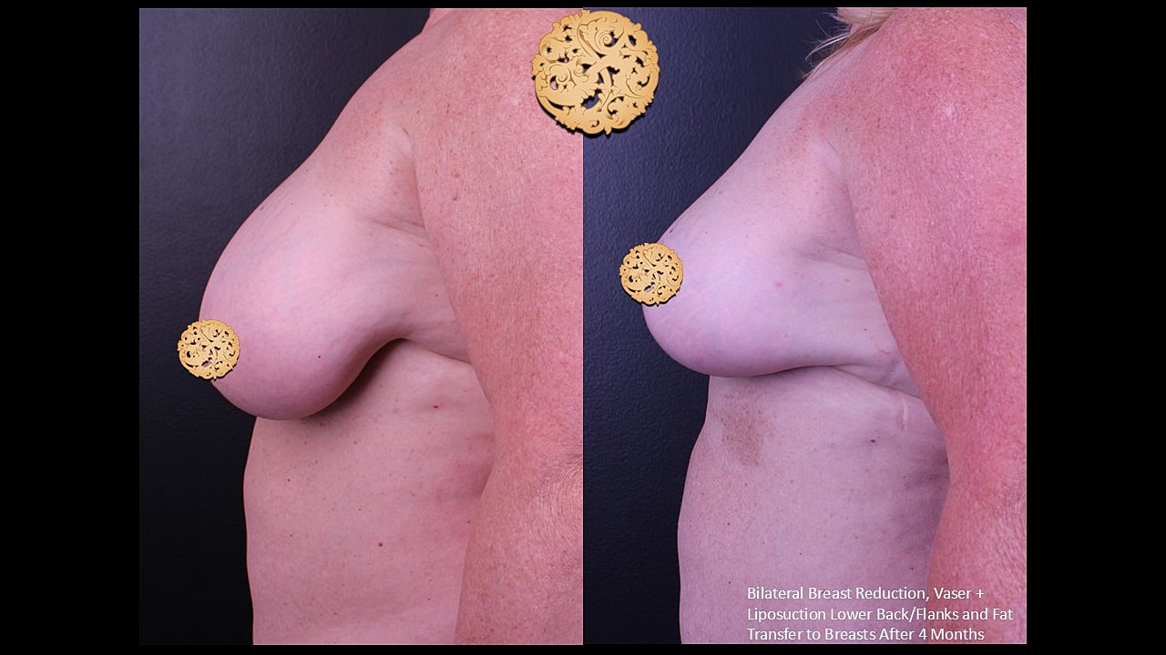 Fat Transfer To Breasts Before & After