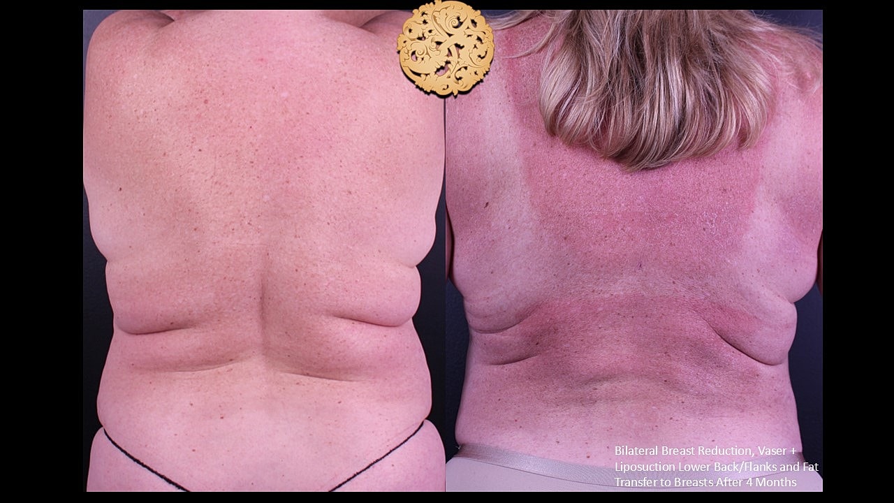 Fat Transfer To Breasts Before & After