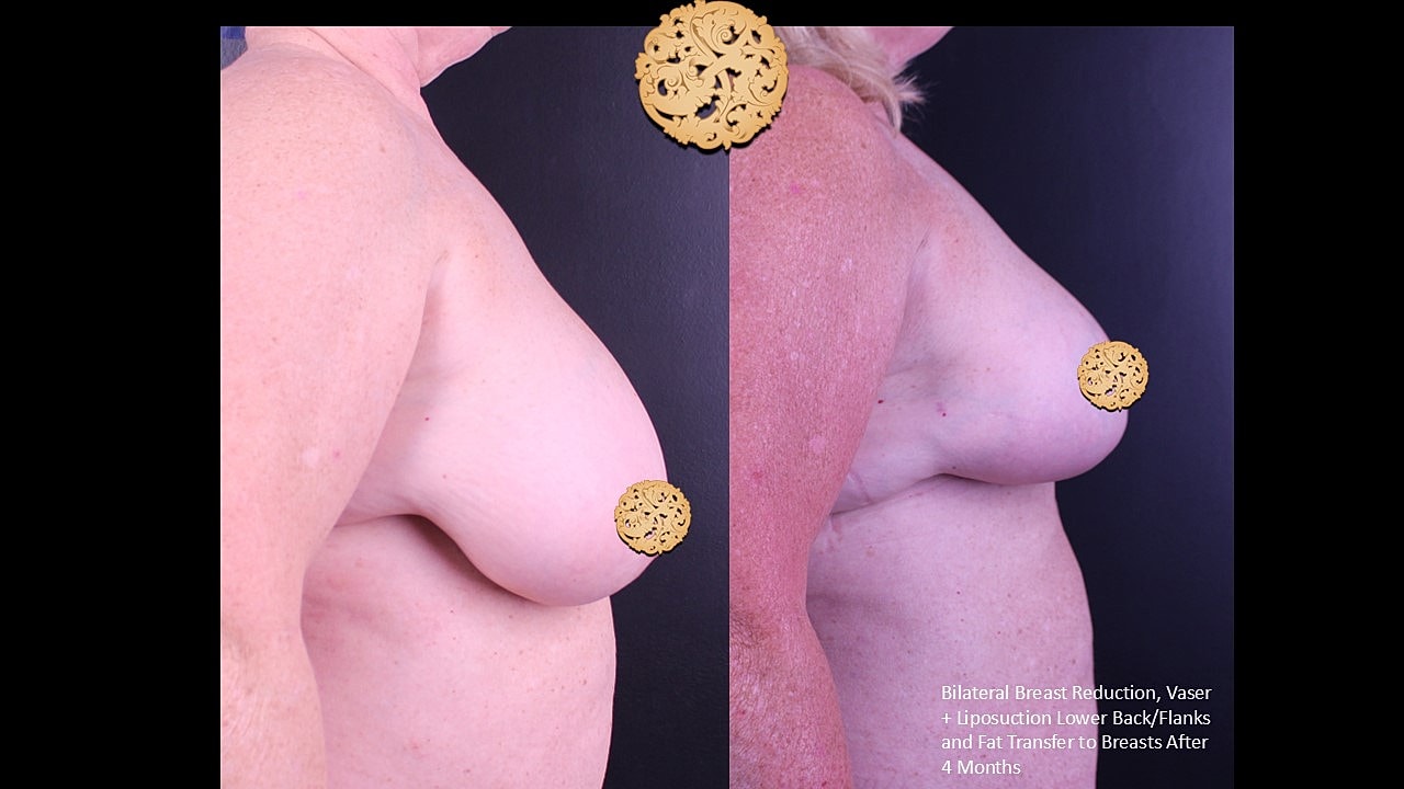 Fat Transfer To Breasts Before & After