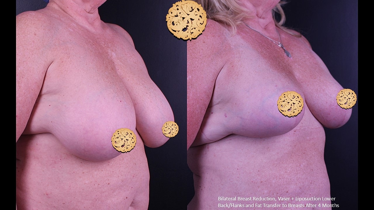 Fat Transfer To Breasts Before & After