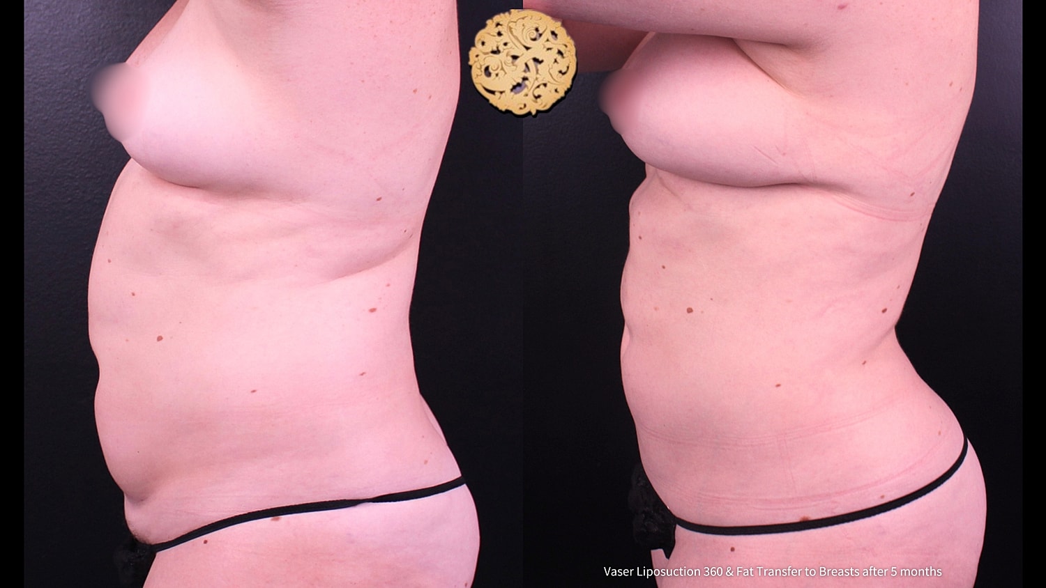 Fat Transfer To Breasts Before & After