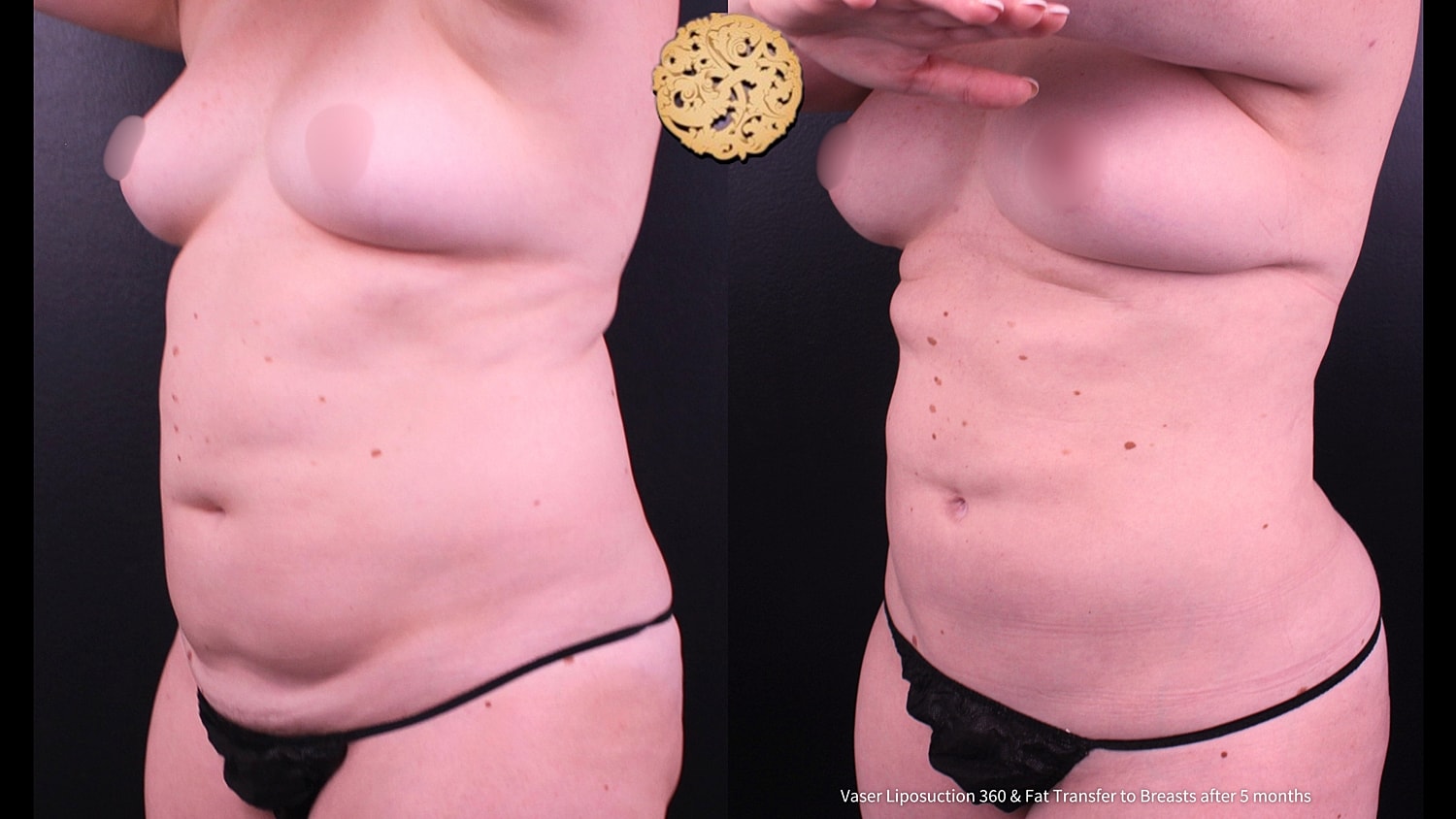 Fat Transfer To Breasts Before & After