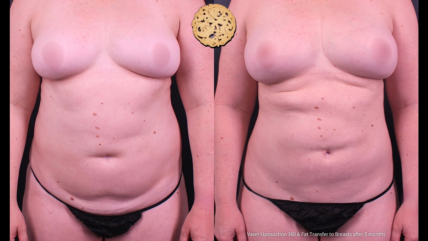 Fat Transfer To Breasts Before & After