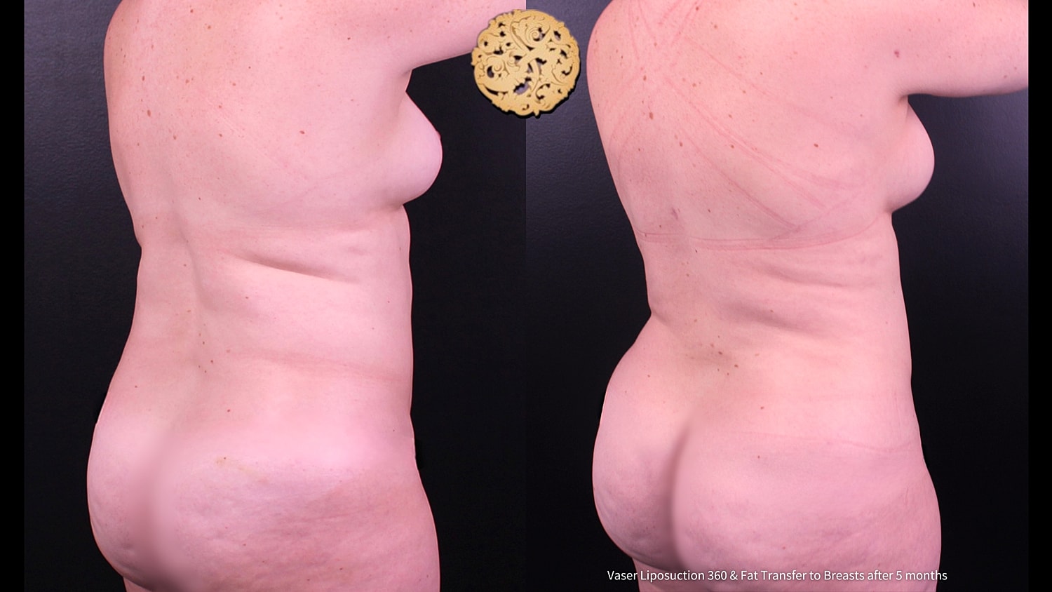 Fat Transfer To Breasts Before & After