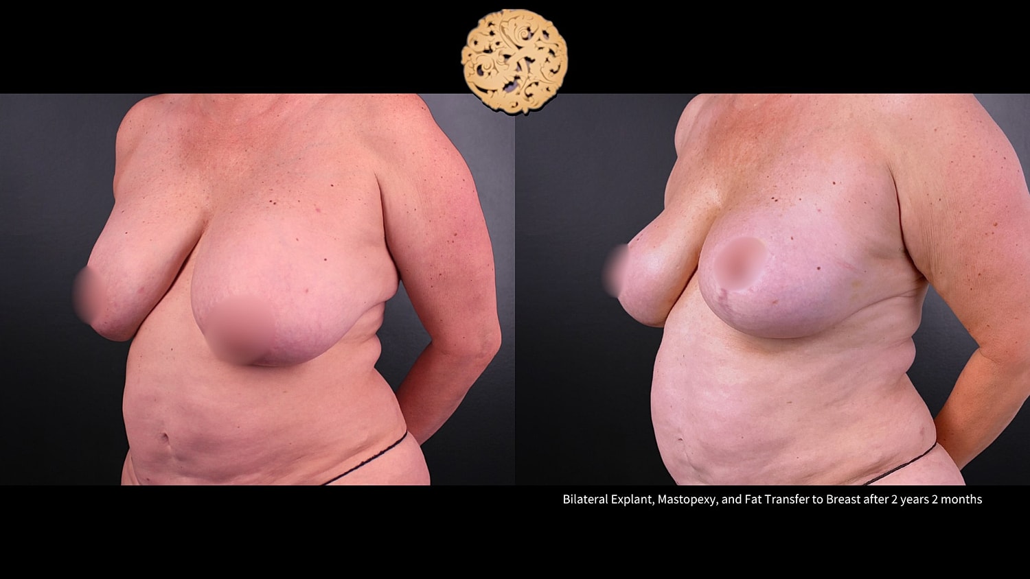 Fat Transfer To Breasts Before & After