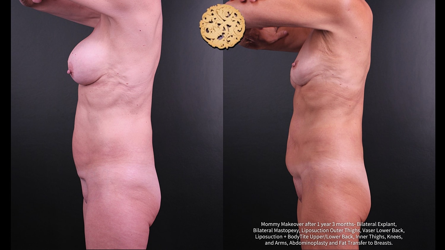 Fat Transfer To Breasts Before & After