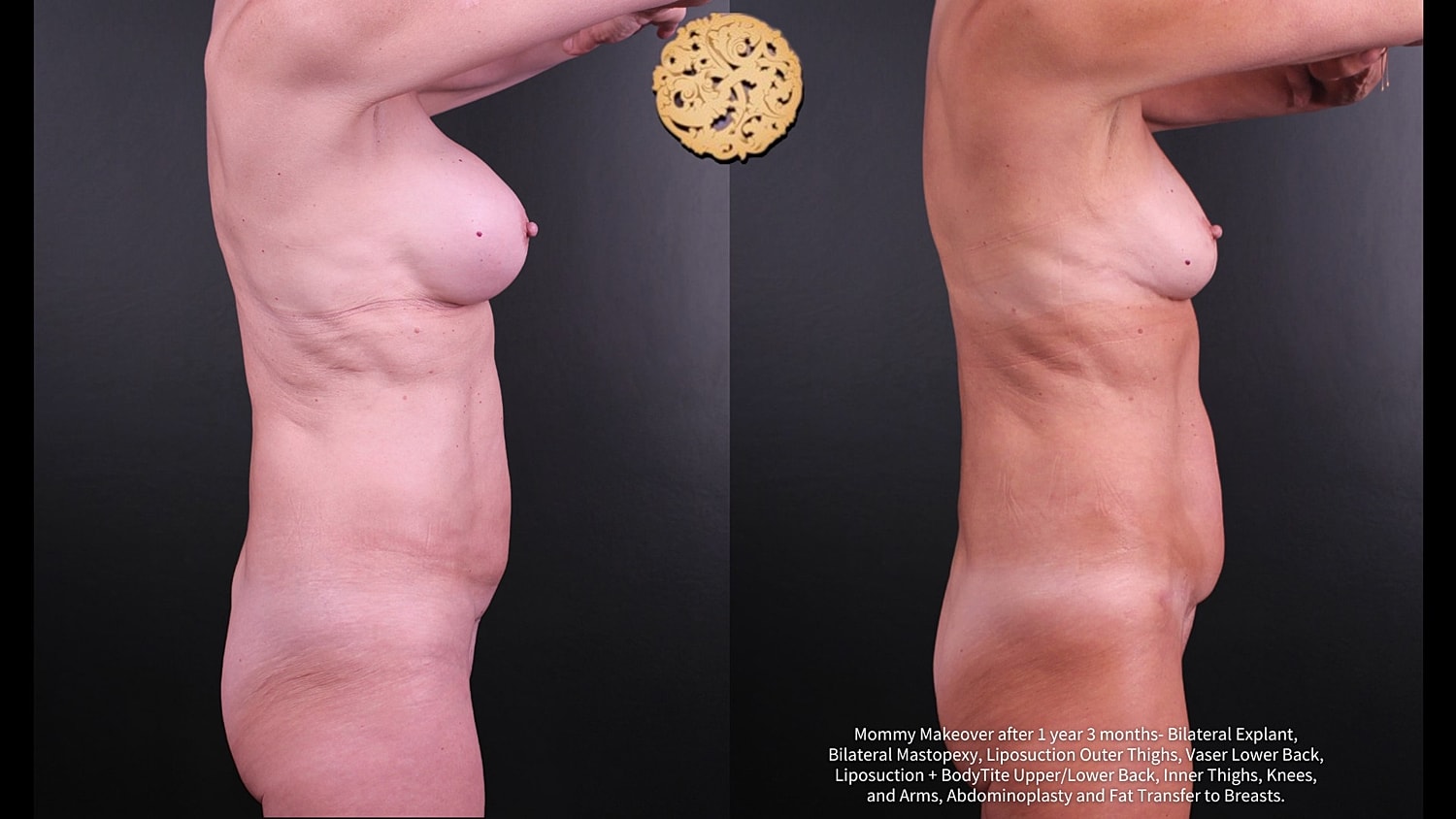 Fat Transfer To Breasts Before & After